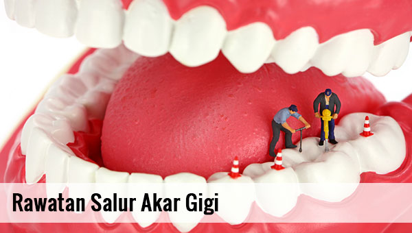 Rawatan Salur Akar Gigi (root canal)